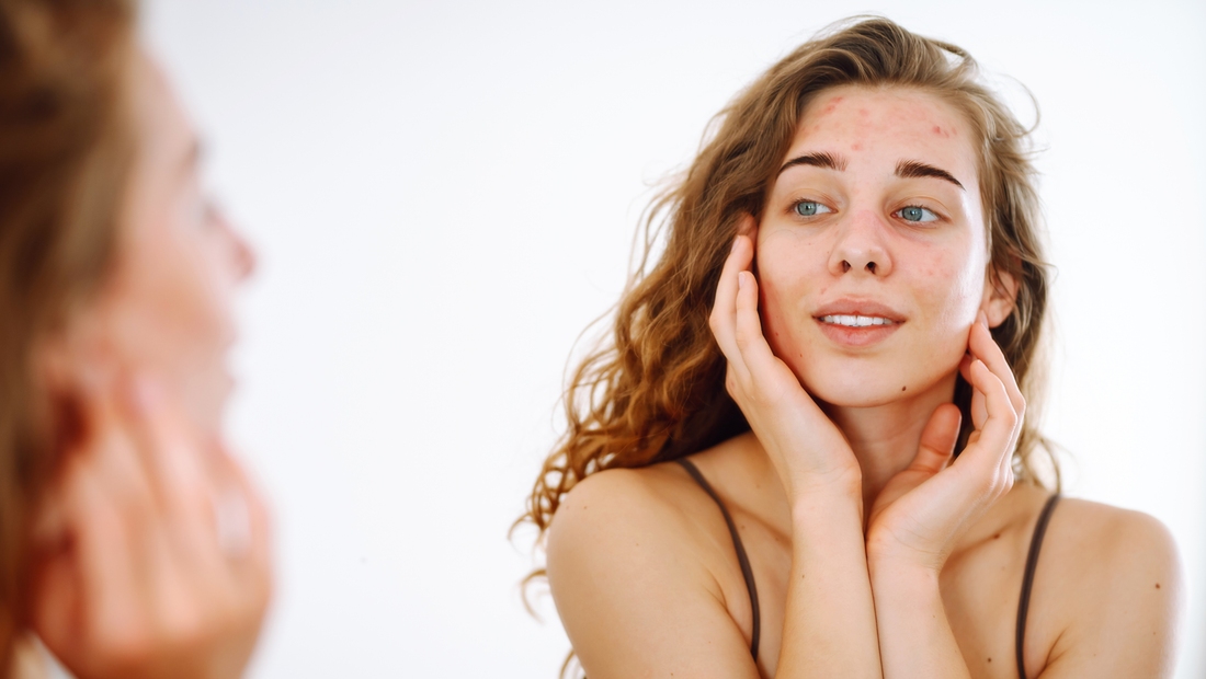 Hormone & Hautbild: Wie dein Hormonhaushalt deine Haut beeinflusst (Teil 5)